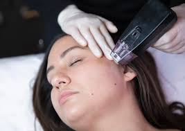 Preparing Your Skin Successfully for a Morpheus8 Treatment